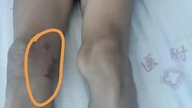 左膝长骨瘤却被错切右膝！主刀医生被撤职
