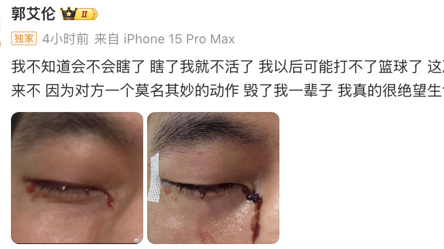 可能打不了篮球了！知名球员郭艾伦眼部受伤缝了40多针 俱乐部回应