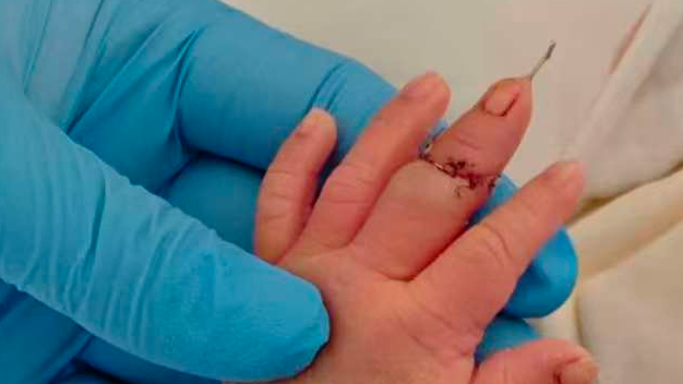 江苏一新生儿剪脐带时被剪断手指 助产士称“因孩子的手突然乱动”